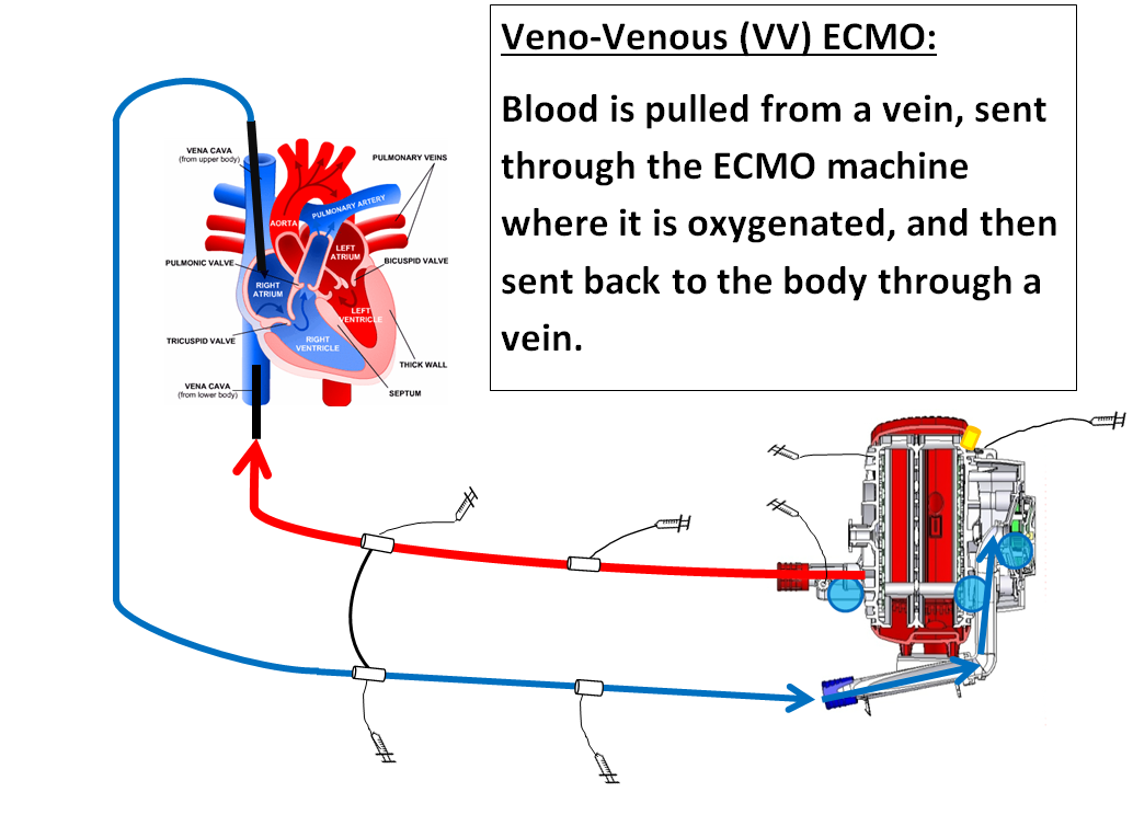 ECMO - Le Bonheur Children's Hospital